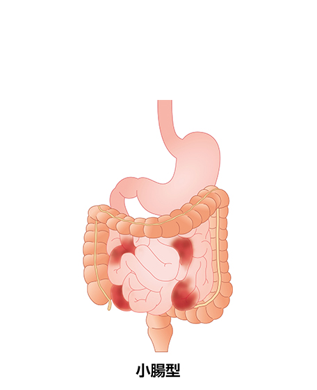 クローン病（小腸型）の画像