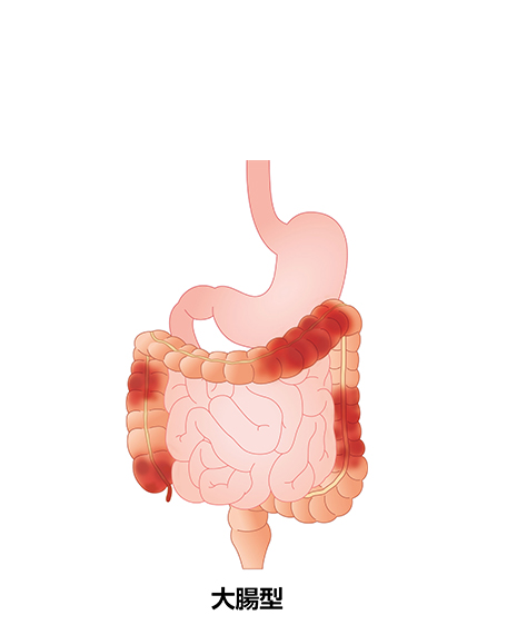 クローン病（大腸型）の画像