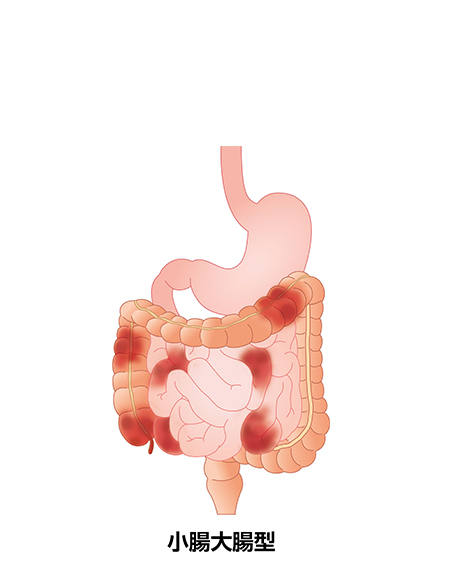 クローン病（小腸大腸型）の画像