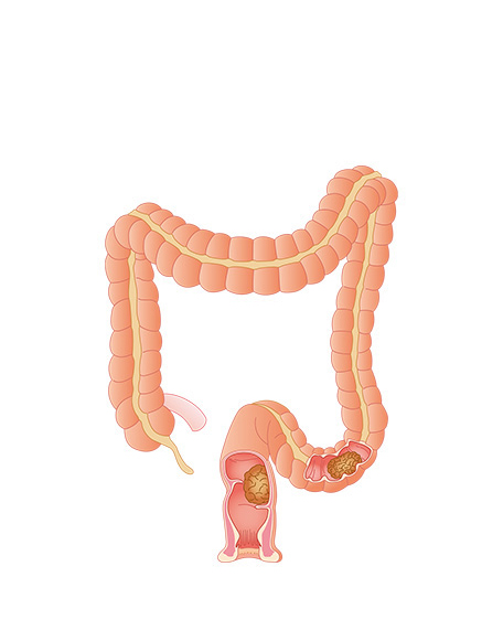 大腸4の画像