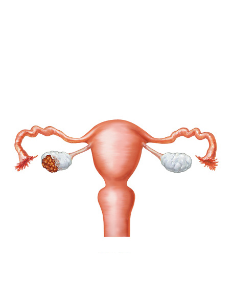 原発性卵巣癌の画像