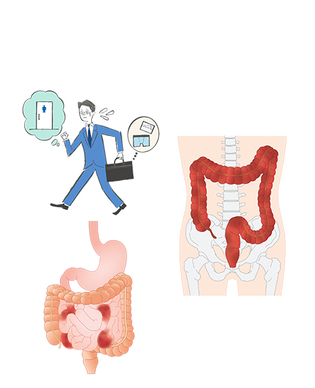 炎症性腸疾患（IBD）の画像
