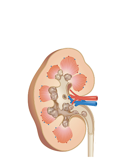 腎結石の画像
