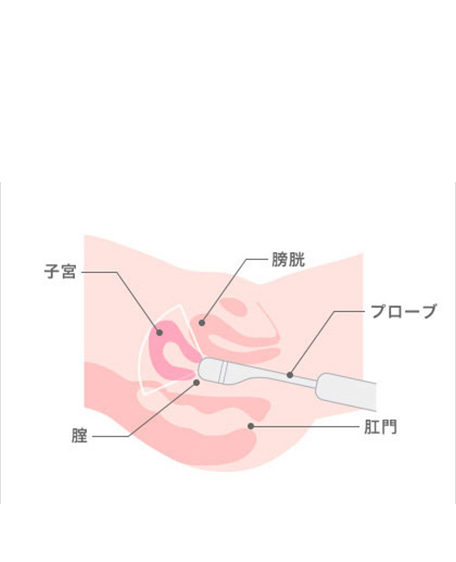 経膣超音波検査2の画像