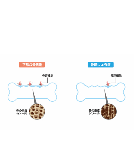 正常な骨代謝と骨粗しょう症の画像