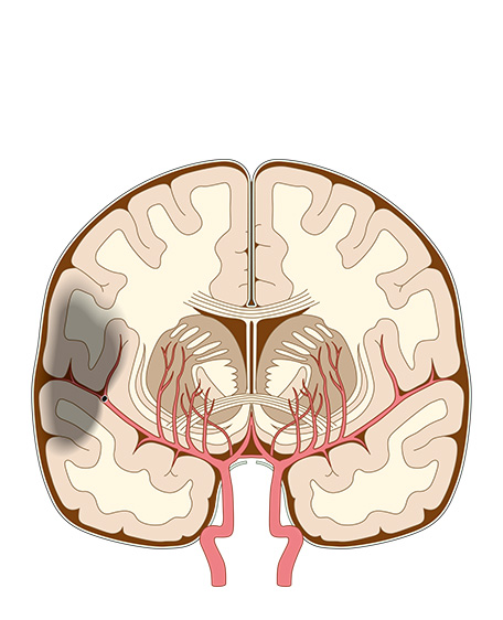 脳梗塞の画像