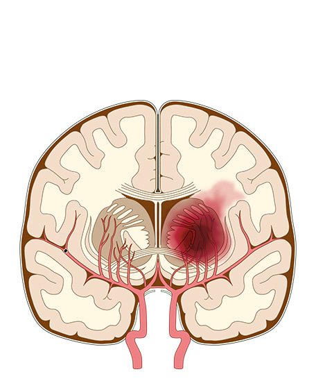 脳出血の画像