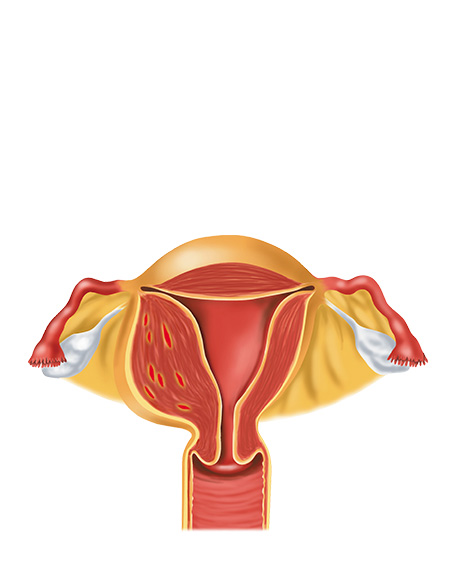 正常子宮図（片方のみ厚い）の画像