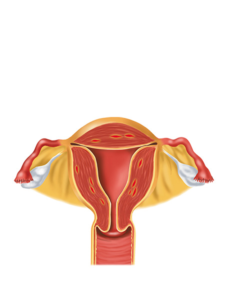 正常子宮図（全体的に厚い）の画像