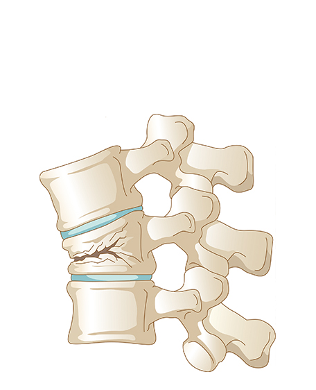 脊椎（圧迫骨折）の画像
