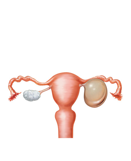 漿液性嚢胞腺腫の画像