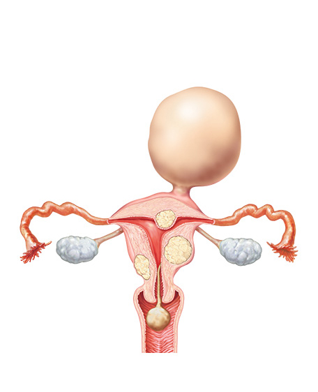 子宮筋腫の画像