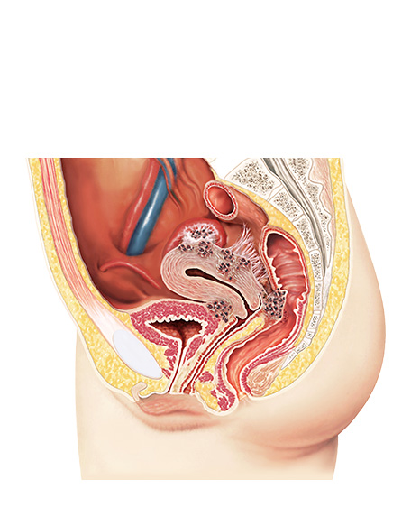 子宮内膜症の発生部位の画像
