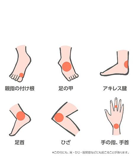 痛風発作が起こりやすい場所の画像