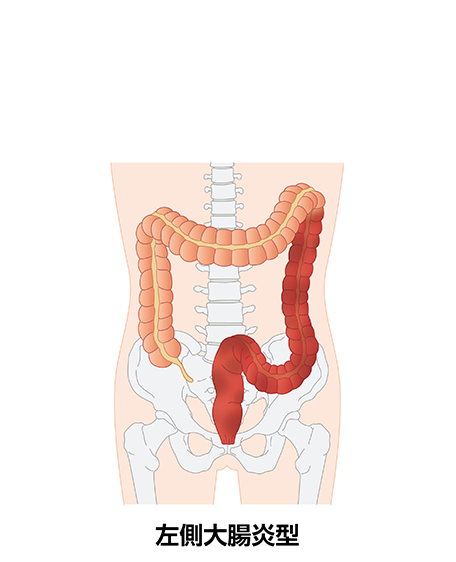 潰瘍性大腸炎（左側大腸炎型）の画像