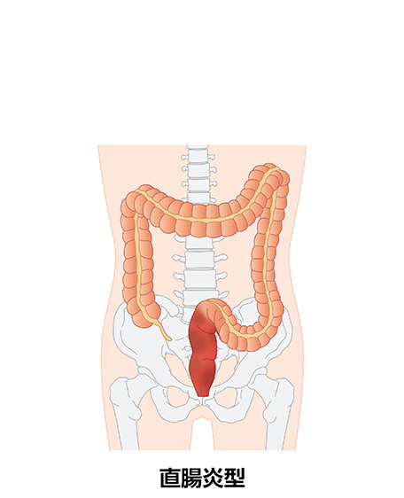 潰瘍性大腸炎（直腸炎型）の画像