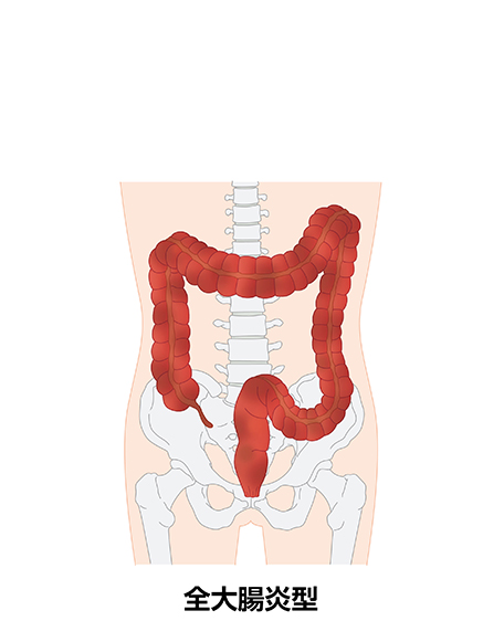 潰瘍性大腸炎（全大腸炎型）の画像