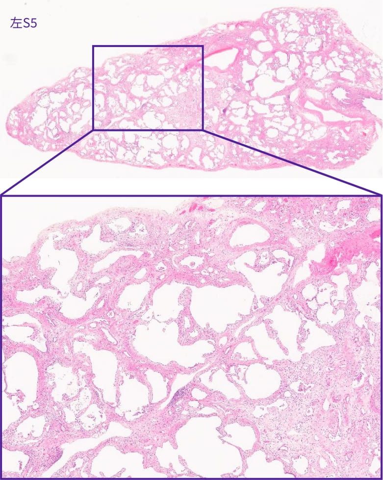 特発性非特異性間質性肺炎