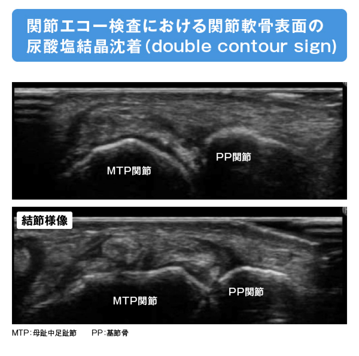 関節エコー検査における関節軟骨表面の尿酸塩結晶沈着（double contour sign)の画像