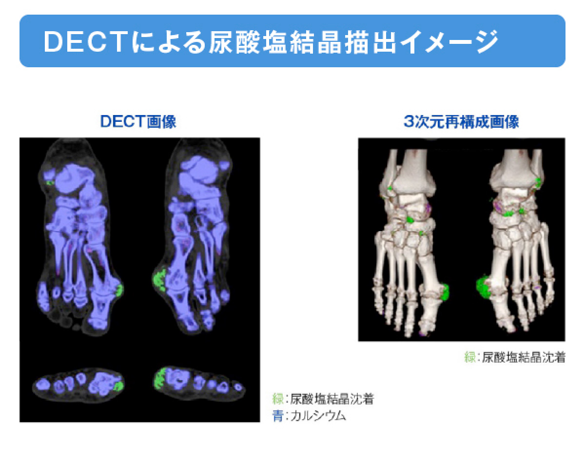 DECTによる尿酸塩結晶描出イメージの画像