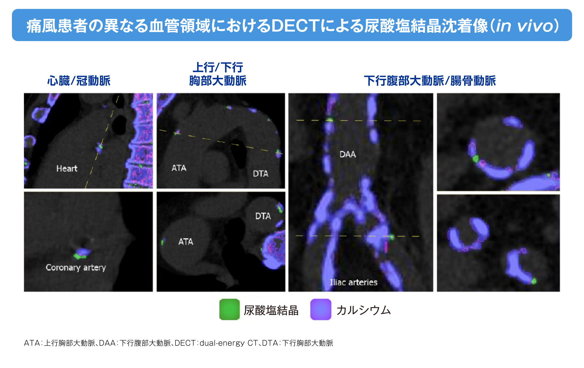 痛風患者の異なる血管領域におけるDECTによる尿酸塩結晶沈着像（in vivo）の画像