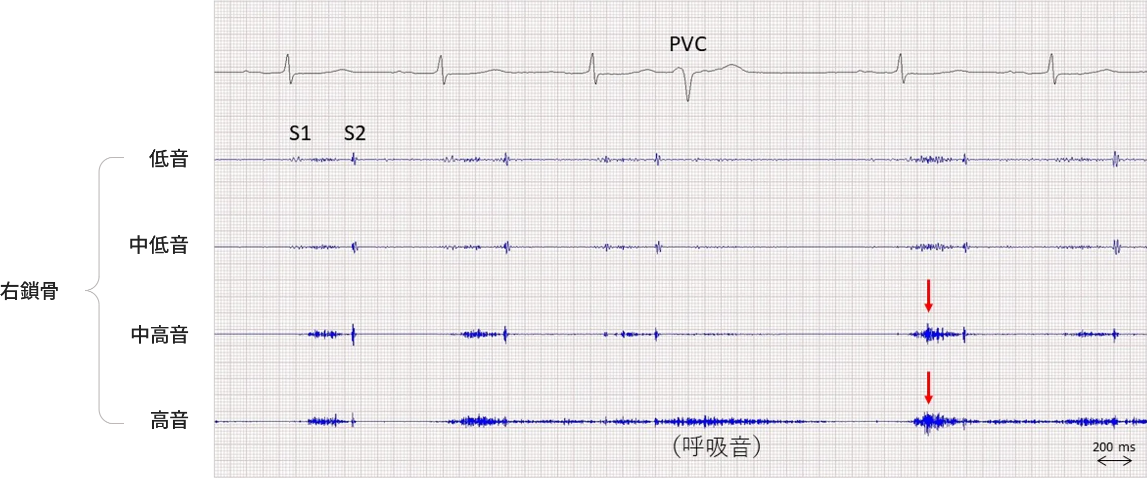 心音図A