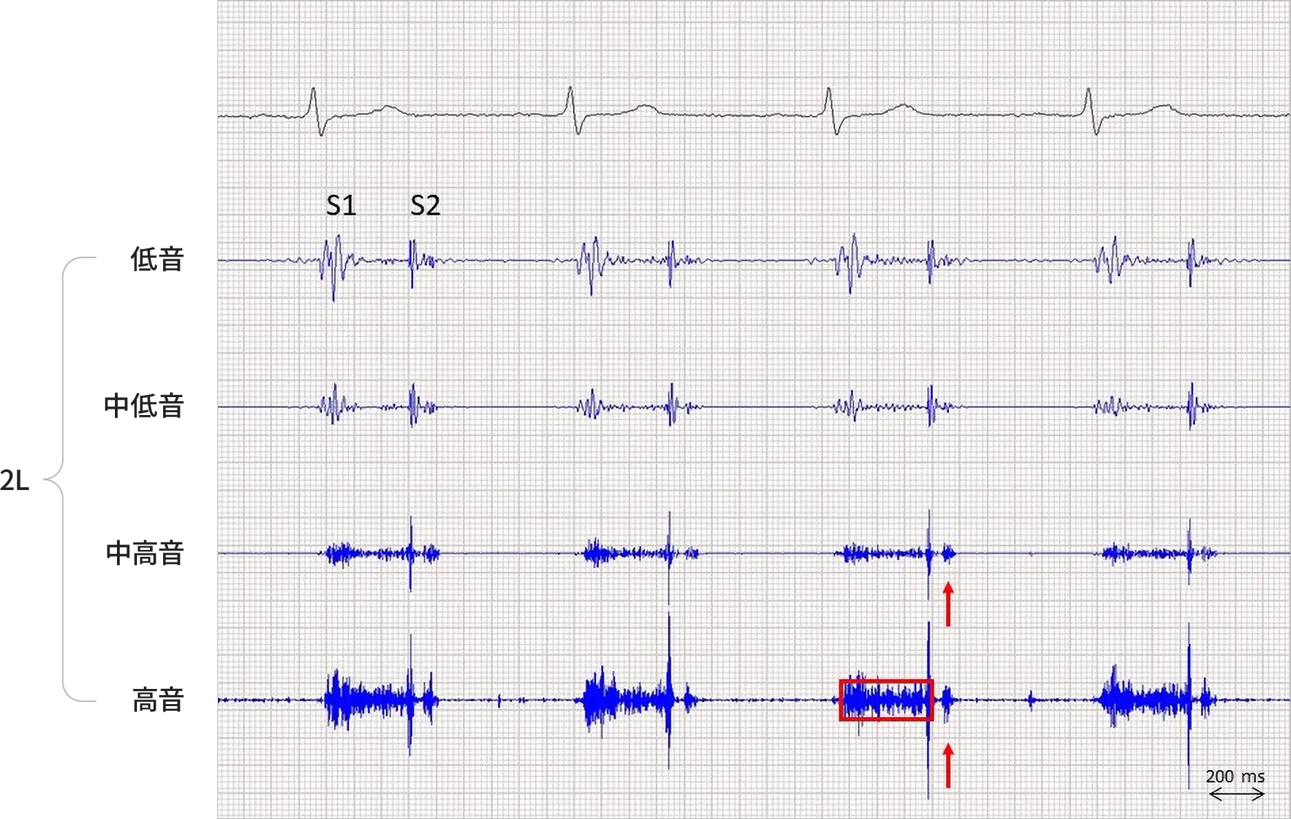 心音図A